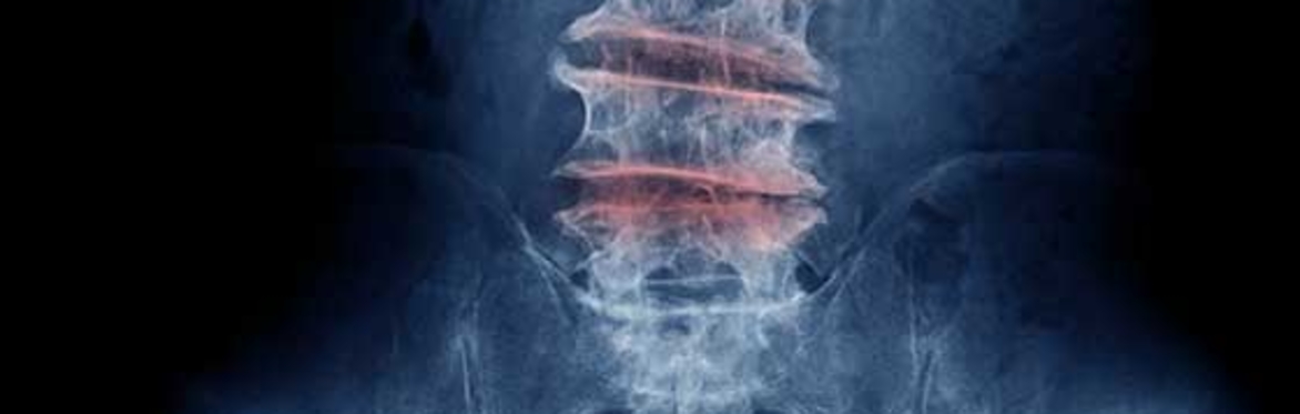 Spinal Arthritis - How to beat the winter months