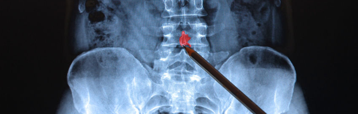 Slipped discs , numbness & sciatica