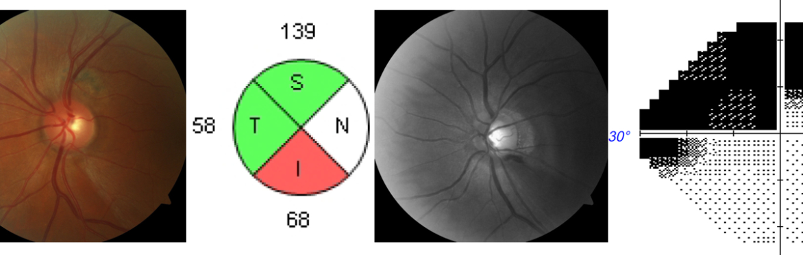 Glaucoma Update