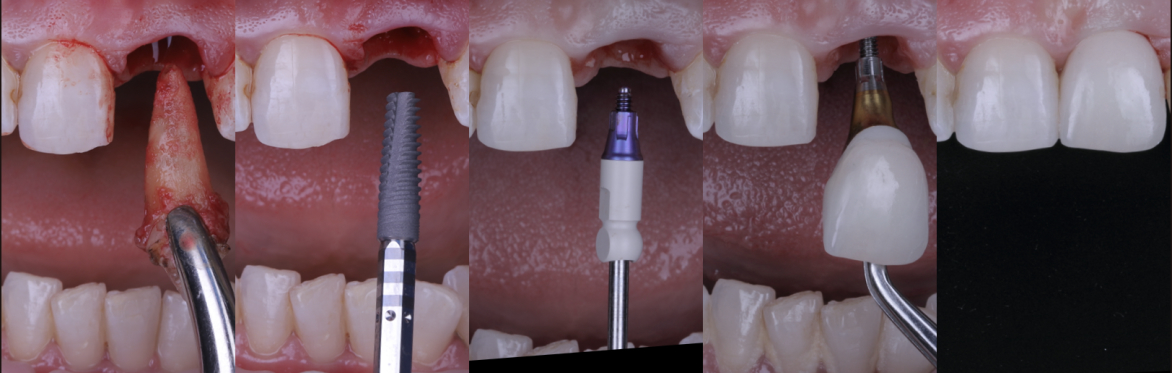Predictable Immediate Implants