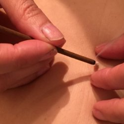 two hands applying rice grain moxa to a person's skin