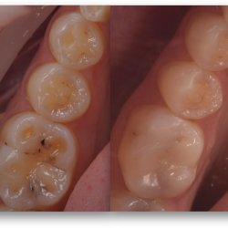 Disruptive Smiles: Sculpt & Layer Posterior Composites with Dr Andrew Chandrapal