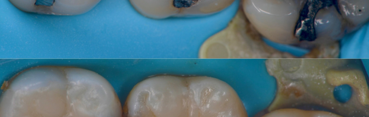 Disruptive Smiles: Sculpt & Layer Posterior Composites with Dr Andrew Chandrapal