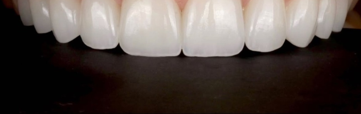 Justin Glaister x Omnia Academy Porcelain Veneers Course