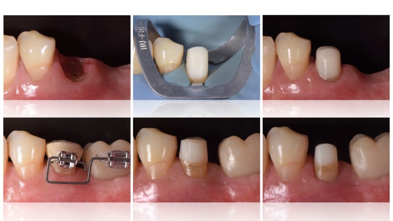 Buy tickets – GUIDO FICHERA - SAVE THE TEETH - Module 3 - Orthodontic ...